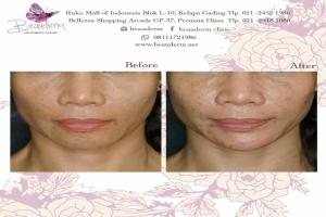 Chin Augmentation / Filler Dagu