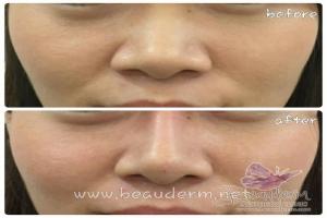 Filler Hidung / Nose Filler