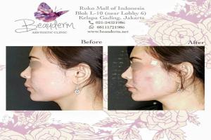 Cheek Augmentation / Filler Pipi