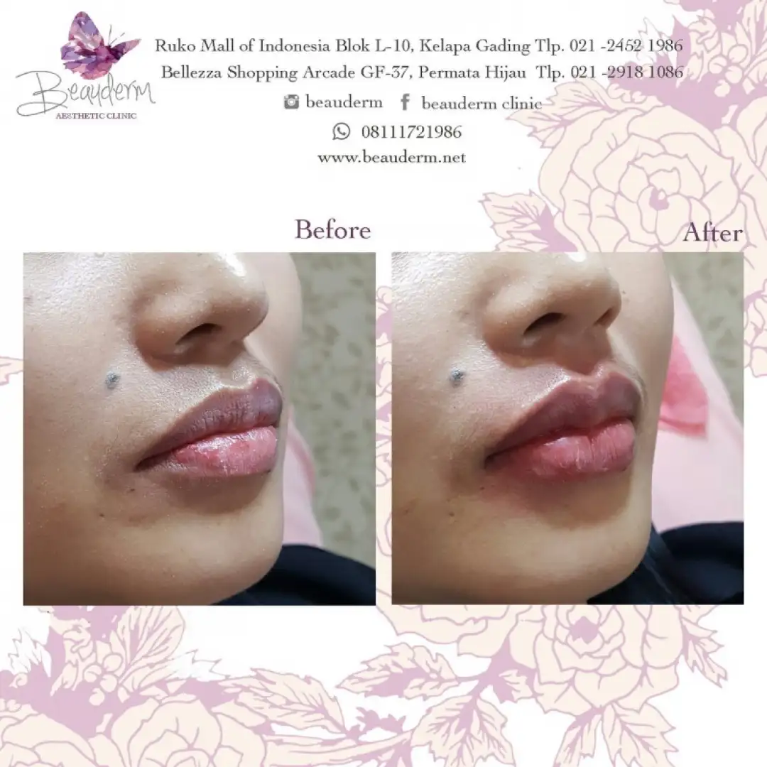 Lips Filler / Filler Bibir