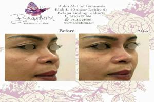 Filler Hidung / Nose Filler