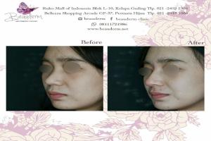 Filler Hidung / Nose Filler