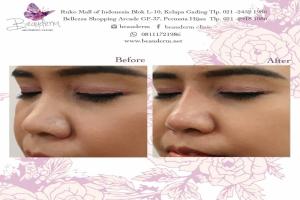 Filler Hidung / Nose Filler