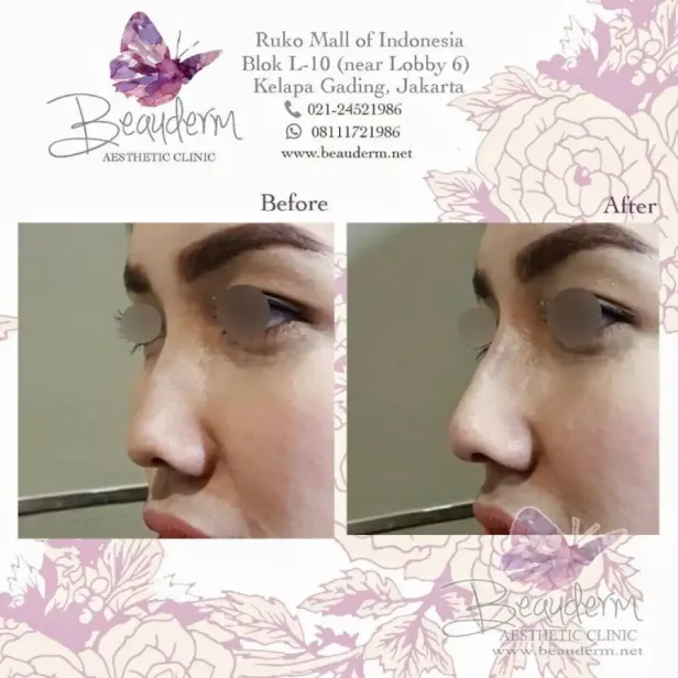 Filler Hidung / Nose Filler
