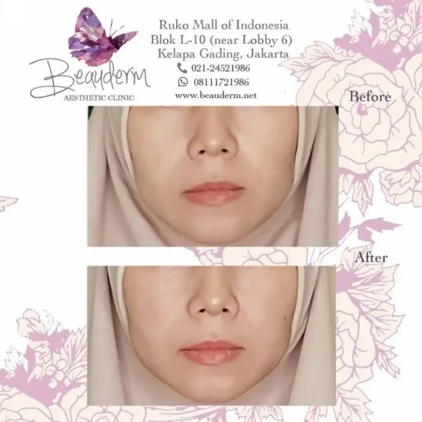 Smile Line Filler