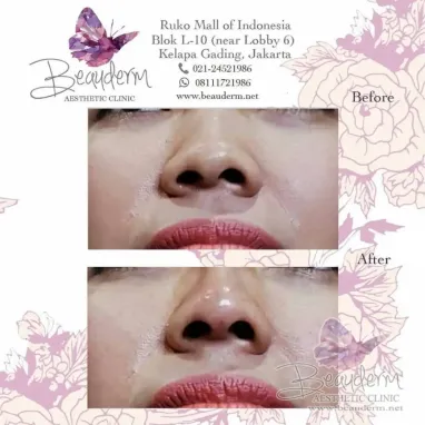 gallery img: Filler Hidung / Nose Filler
