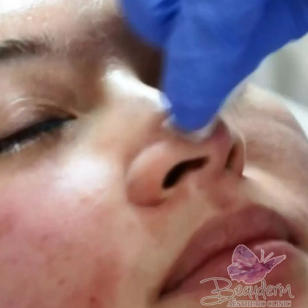 Suntik Filler Hidung Di Jakarta - Aesthetic Clinic
