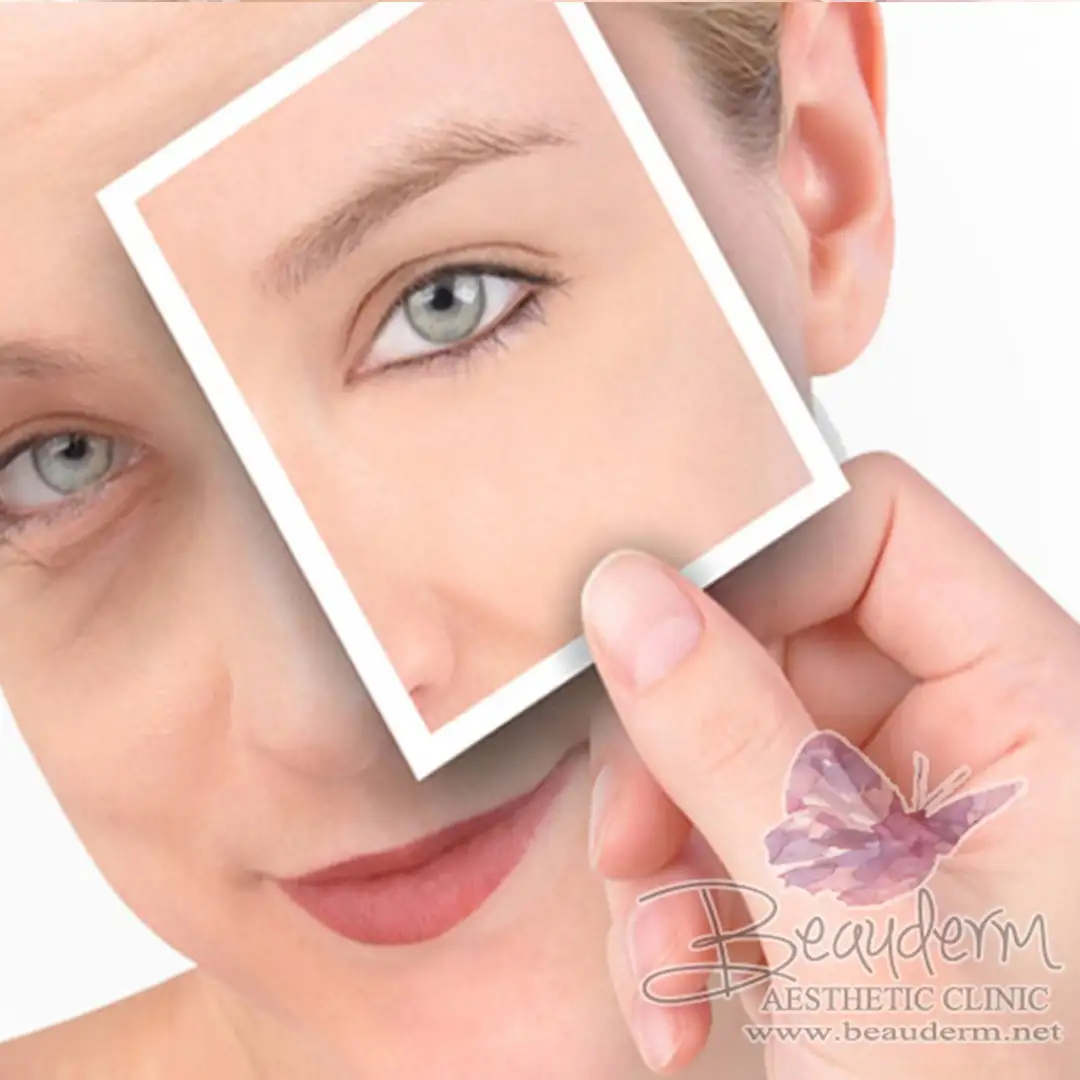 Penyebab Terjadinya Kantung Mata (Eye Bag)
