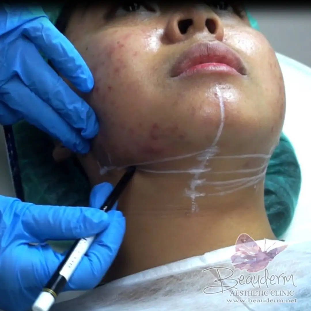 Treatment Menghilangkan Double Chin
