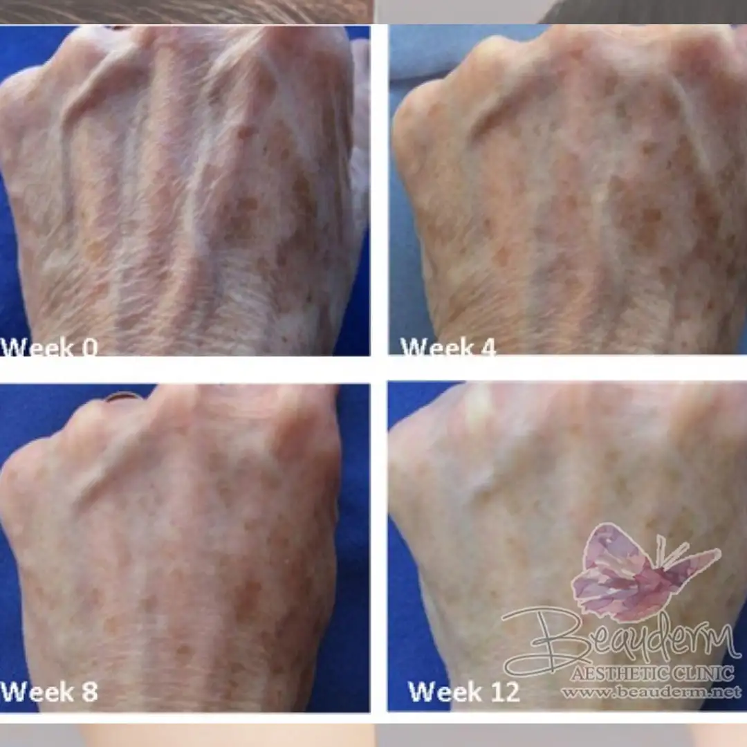 Perawatan Peremajaan Kulit (Skin Rejuvenation) Agar Tampak Awet Muda