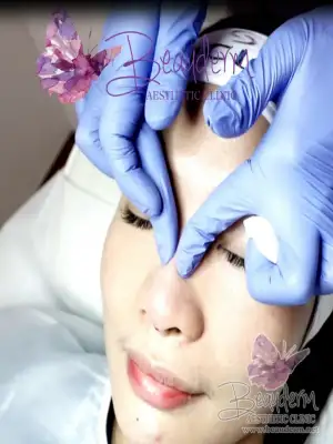 Proses Suntik Filler Agar Hidung Lebih Tegas dan Mancung